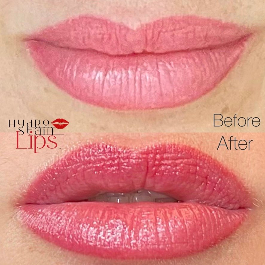 HydroStain Lips™ Before and After