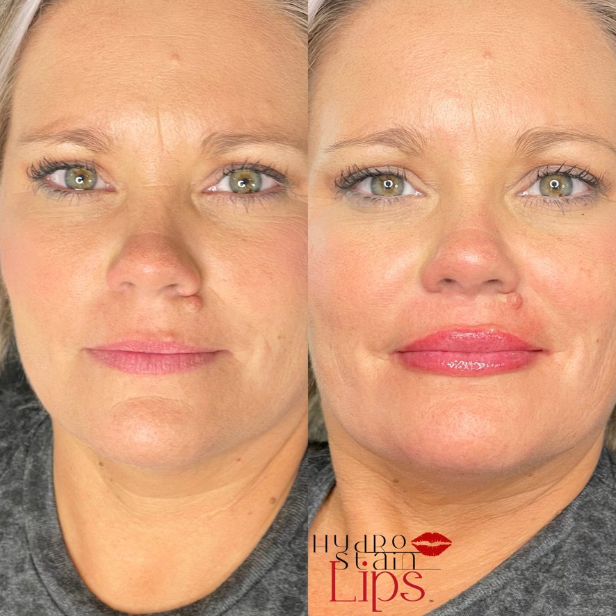 HydroStain Lips™ Before and After