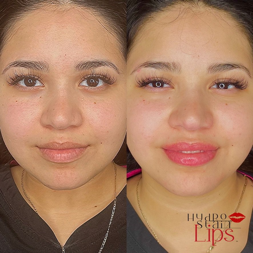HydroStain Lips™ Before and After