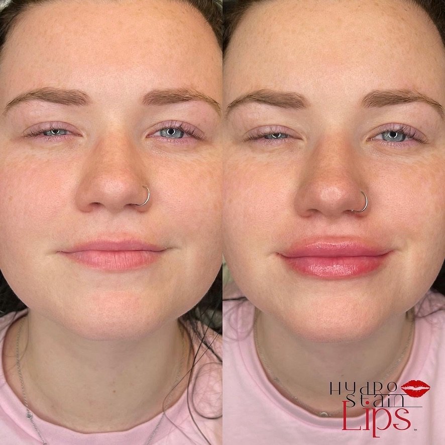 HydroStain Lips™ Before and After