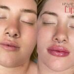 HydroStain Lips Before and After