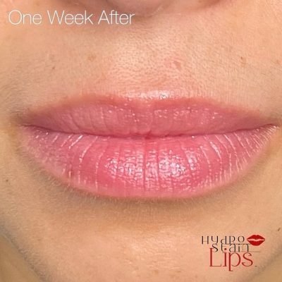 HydroStain Lips™ One Week After HydroStain Lips™ One Week After