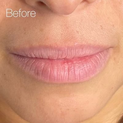 Before HydroStain Lips™ Before HydroStain Lips™